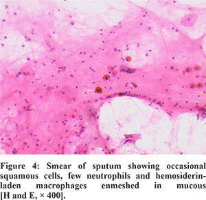 Lane-Hamilton Syndrome: Rare Association Of Idiopathic Pulmonary ...